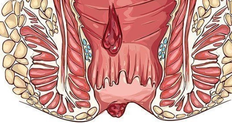 Анальный секс и геморрой: есть ли связь?